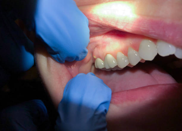 Best Emergency Treatment for Dental Infections or Abscesses in Mount Juliet, TN