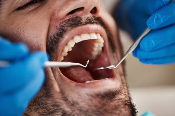 Best Emergency Tooth Extraction in Mount Juliet, TN